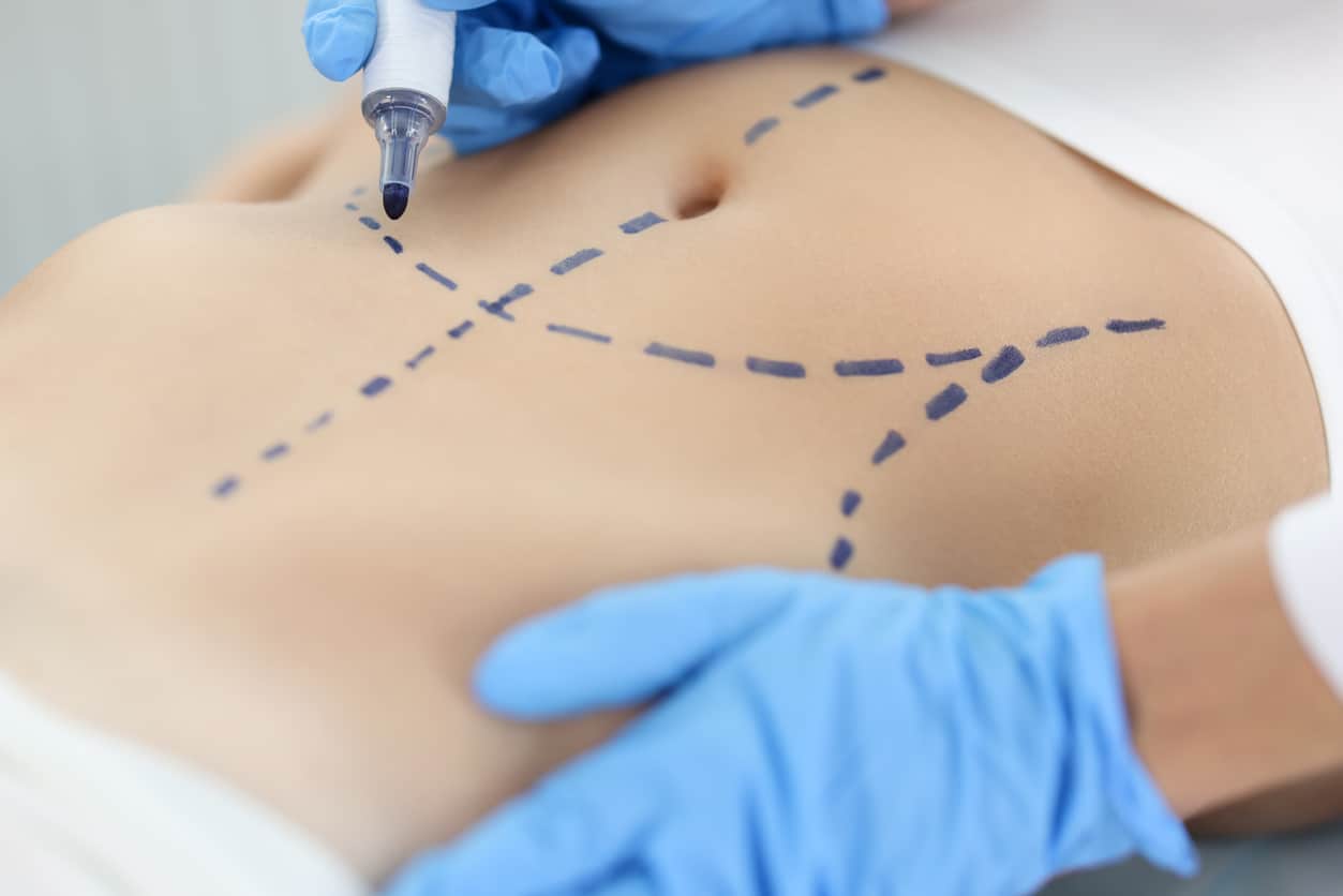A Medical Professional Draws Dotted Lines On A Patient’s Stomach With A Blue Marker Before A Liposuction Procedure